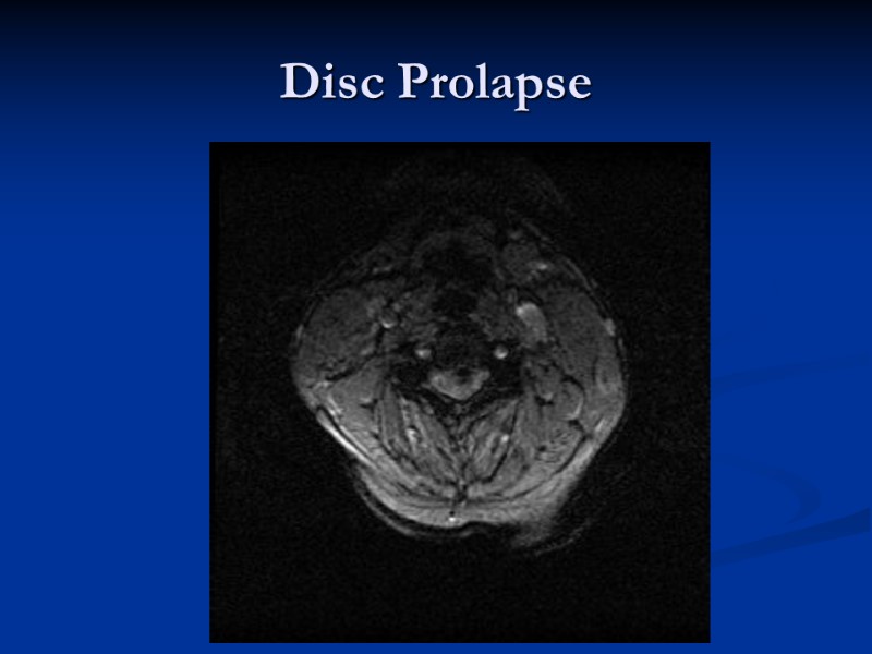 Disc Prolapse